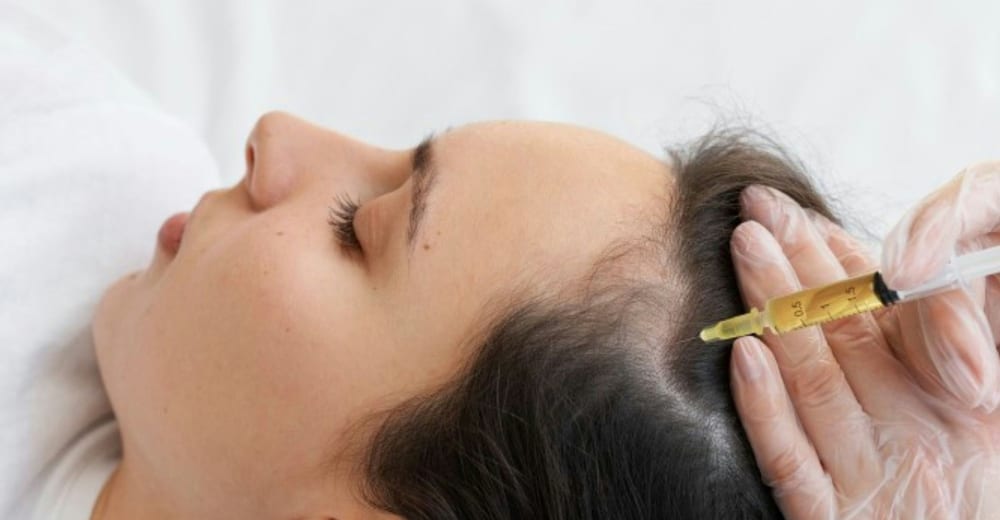 PRP-Eigenbluttherapie an der Kopfhaut bei Haarausfall